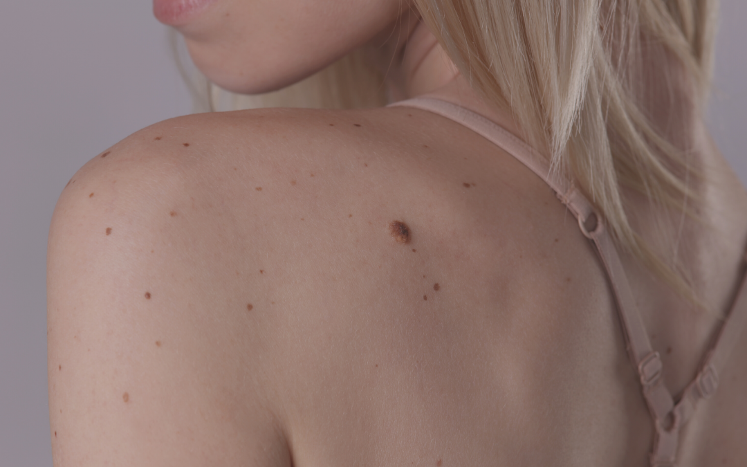 Skin Tags