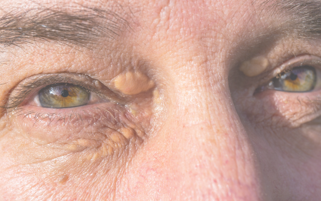 Xanthelasma