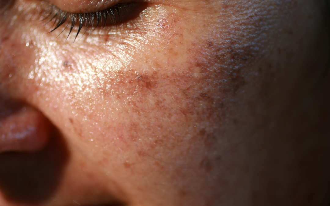 How to get rid of my Age Spots, Liver Spots, and Sun Spots?