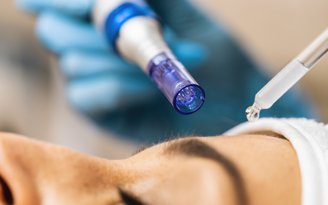 Will Micro-needling work on my wrinkles?