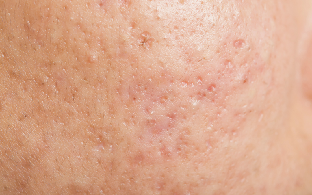 Banish Acne Scars and Reclaim Your Confidence