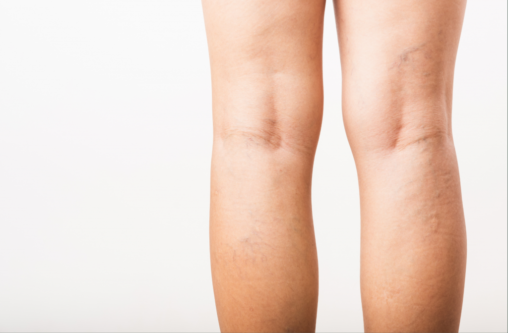 Say Goodbye to Thread Veins - Pure Holistic Beauty