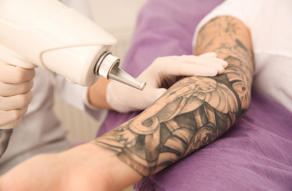 Tattoo Removal: The Essentials - Pure Holistic Beauty