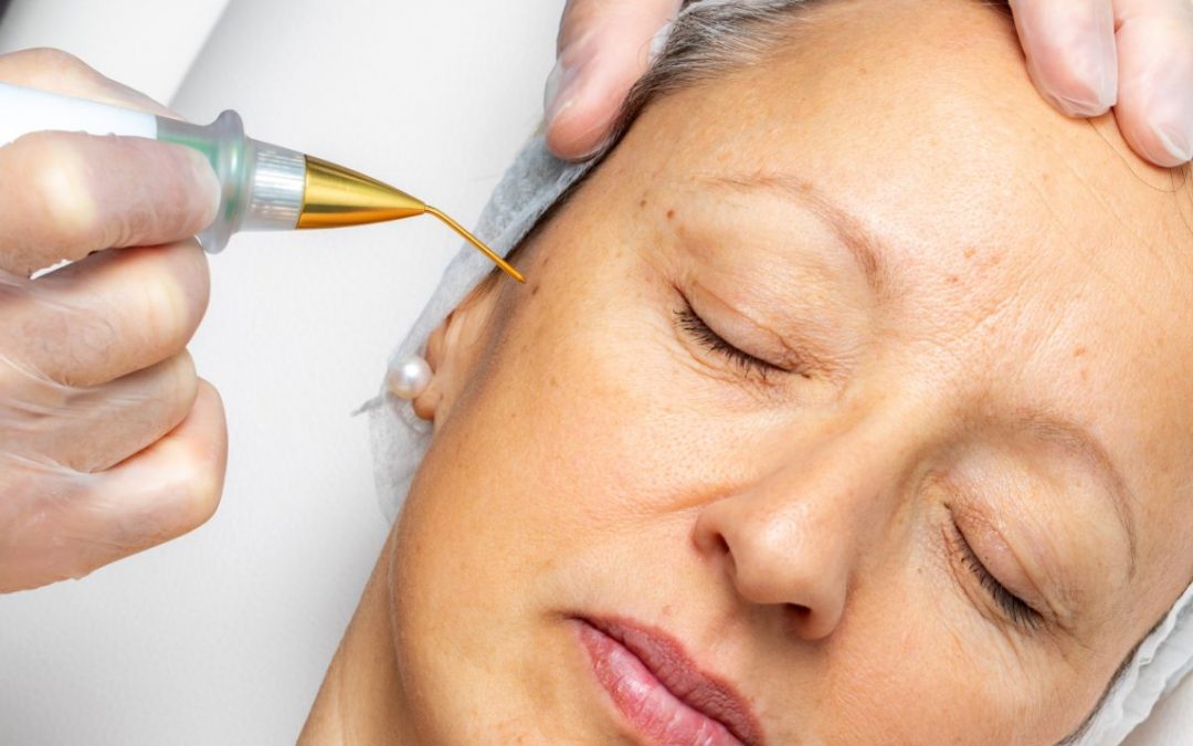 Seborrheic Keratosis Removal in Southampton