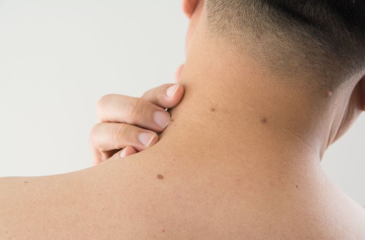 Skin Tags: What You Need to Know