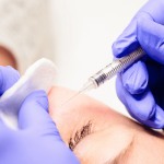 Xanthelasma Removal
