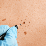 How Long Will Mole Removal Take to Heal