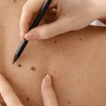 Skin Tag vs Milia: Key Differences & Safe Removal
