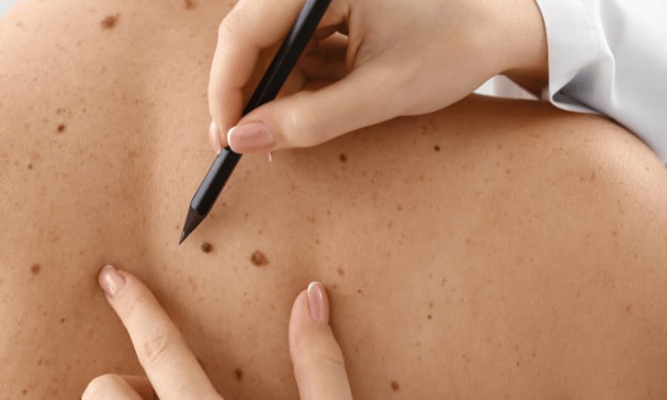 Expert Tips for Blemish Removal Aftercare