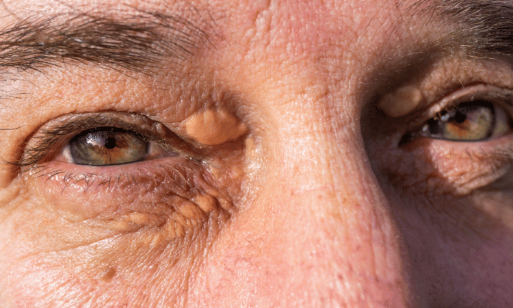 Xanthelasma removal treatment at PURE Holistic Beauty, Southampton