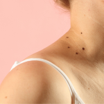 Skin tag removal treatment using advanced electrolysis in Southampton