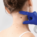 Mole Removal Specialist vs Dermatology Clinics